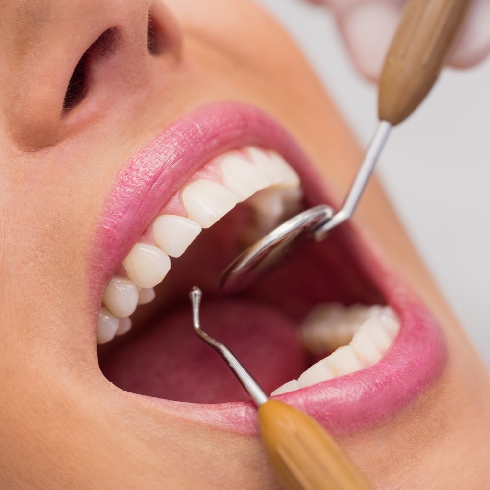 carillas dental europa